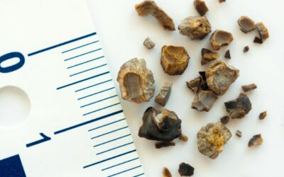 Piedras en el riñón: cómo se forman, síntomas y tratamientos