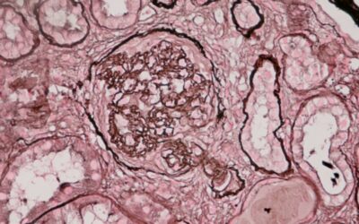 Glomerulonefritis: patología que afecta a la función más importante del riñón